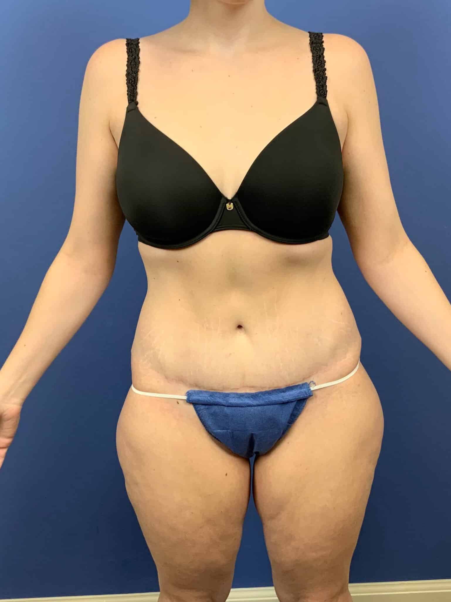 After Image: Tummy Tuck - front