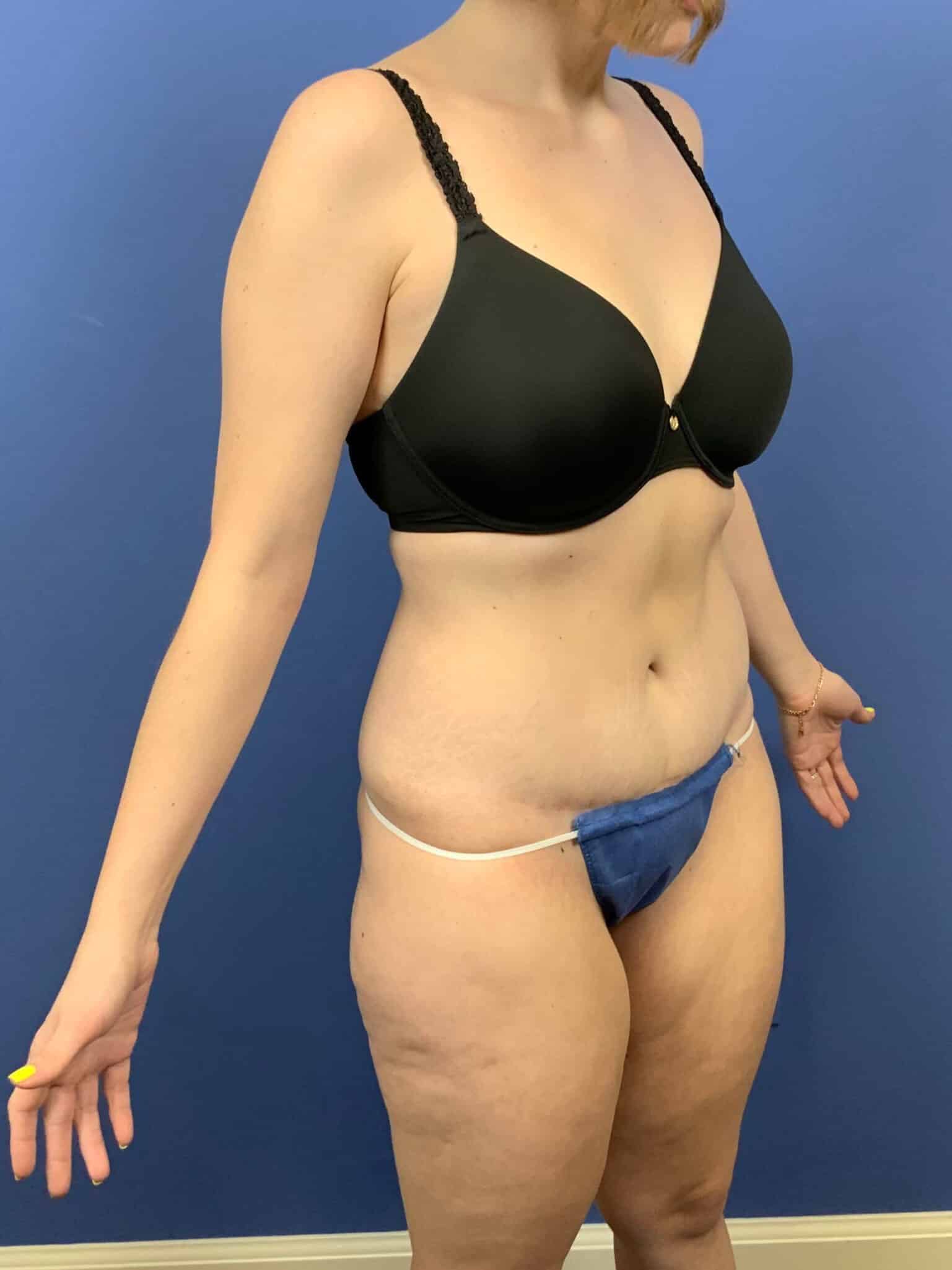 After Image: Tummy Tuck - right-front-oblique