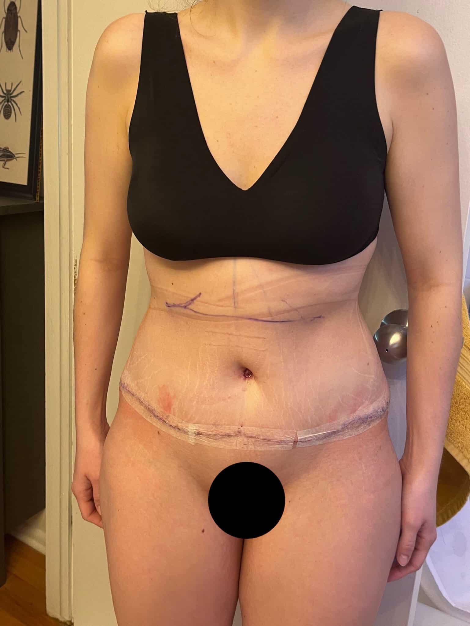 After Image: Tummy Tuck - front