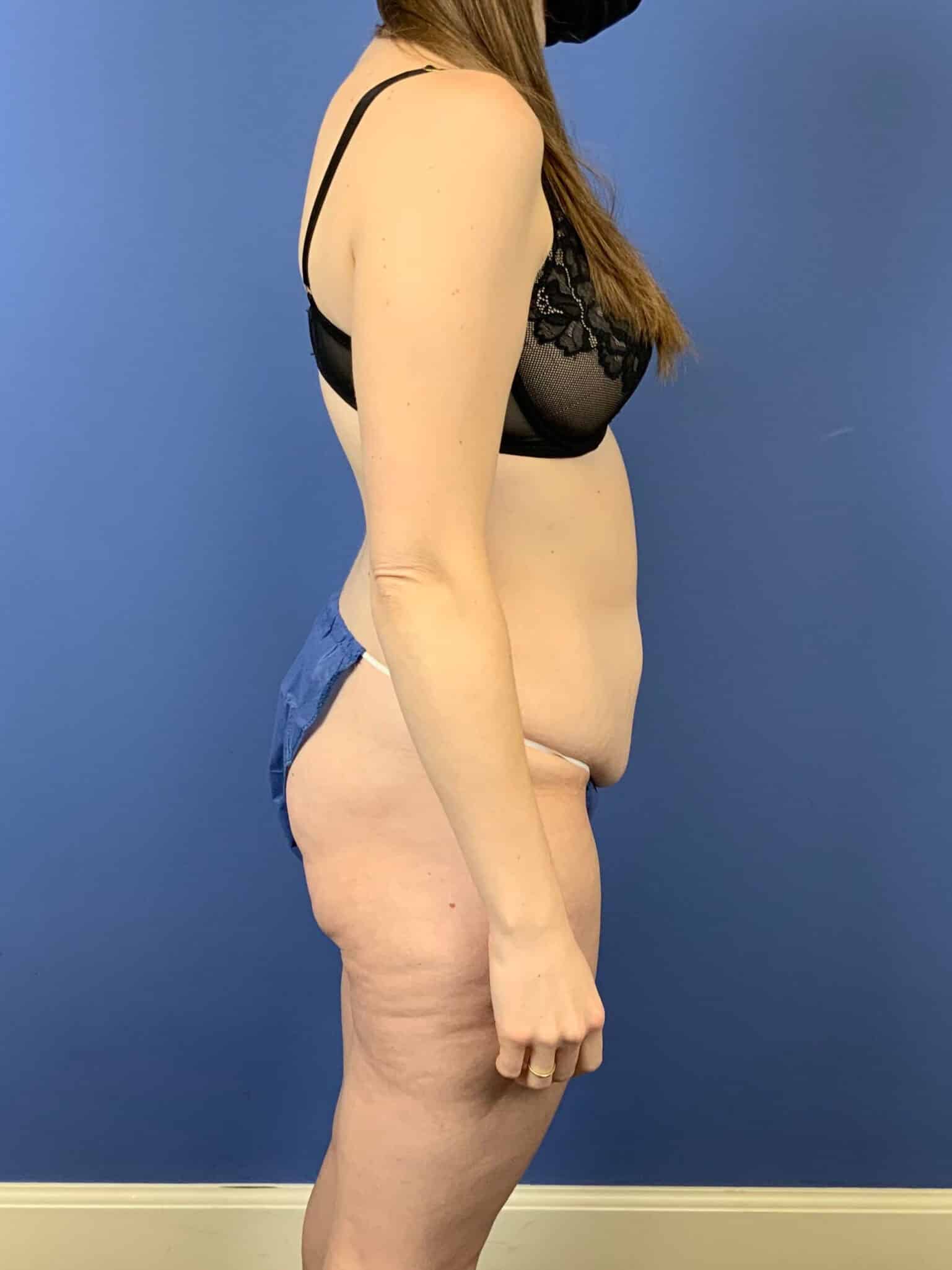 Before Image: Tummy Tuck - right-side