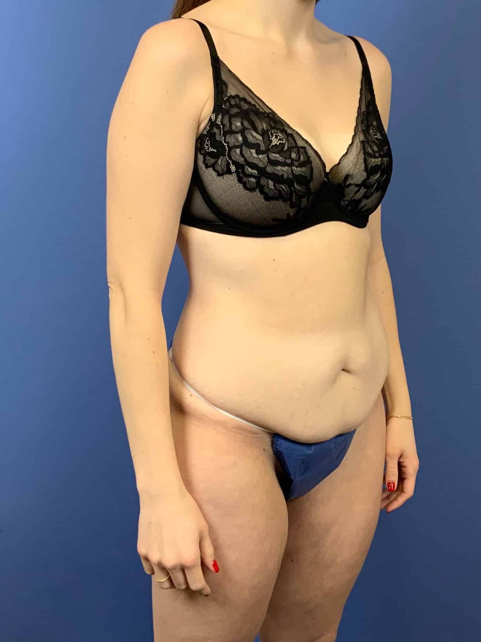 Before Image: Tummy Tuck - right-front-oblique