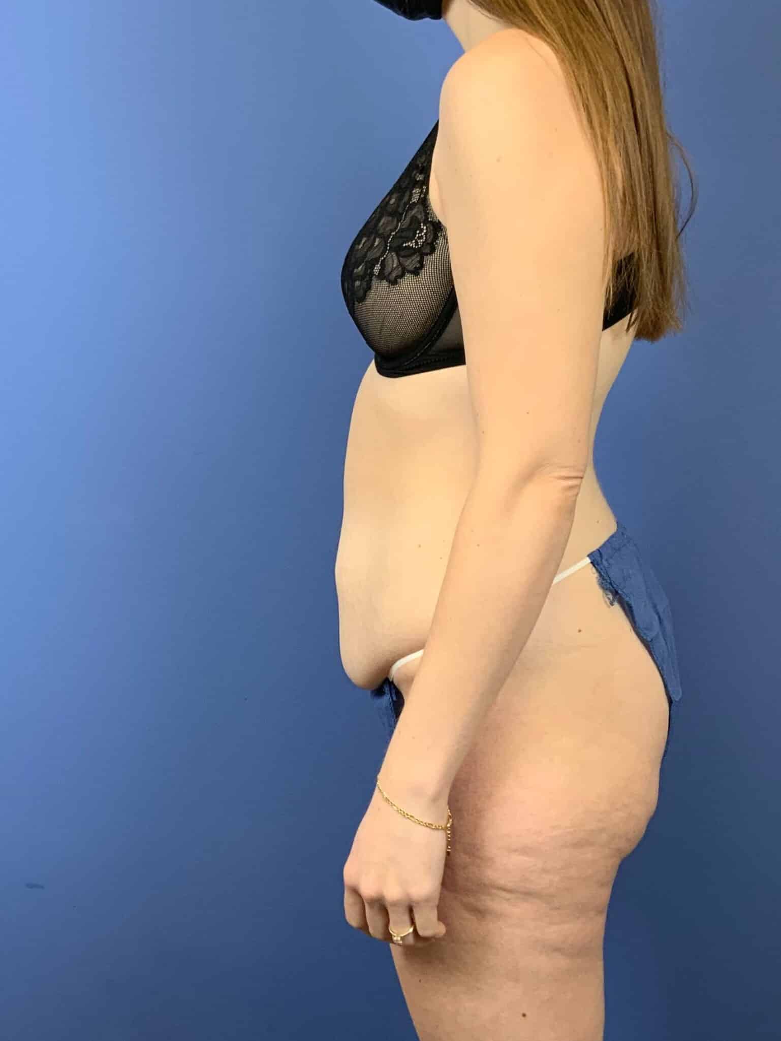 Before Image: Tummy Tuck - left-side