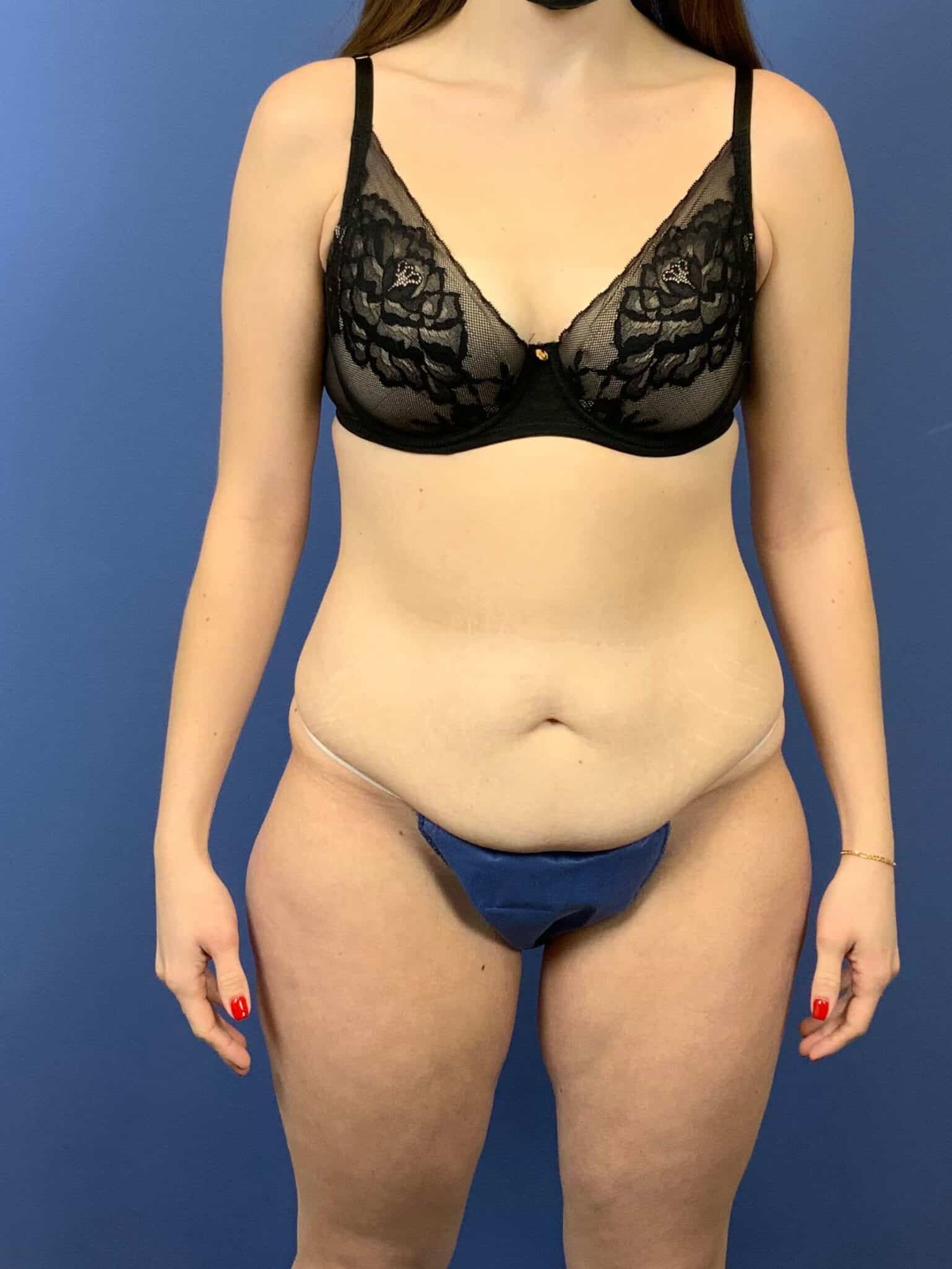 Before Image: Tummy Tuck - front