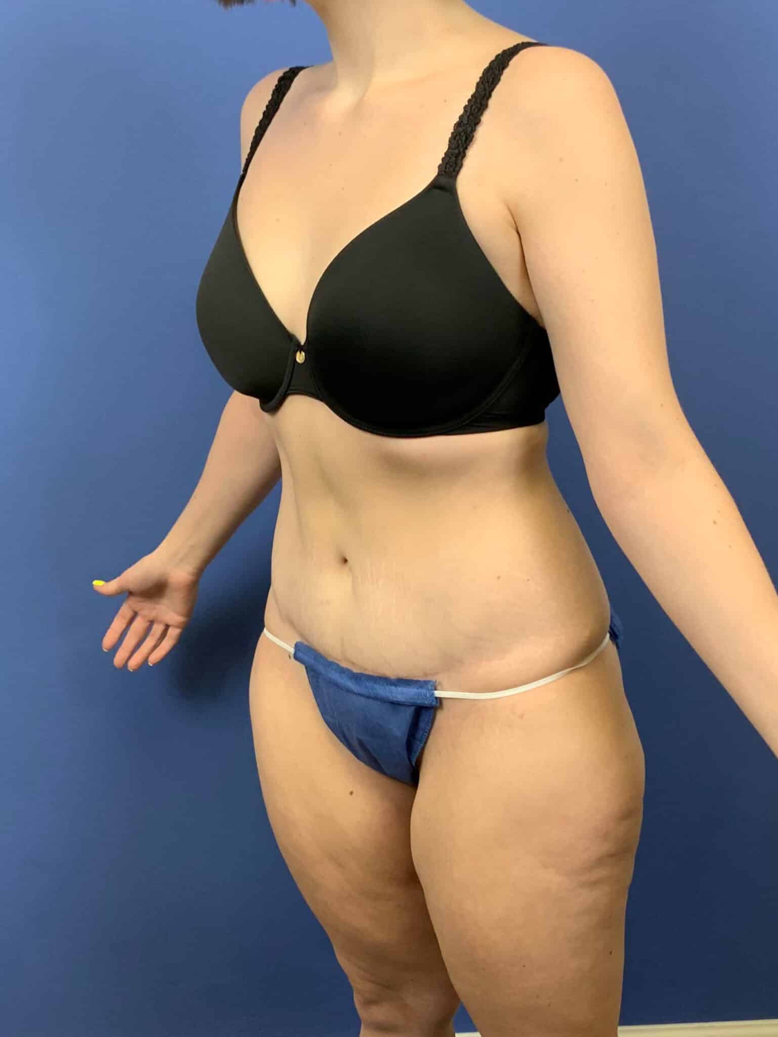 After Image: Tummy Tuck - front