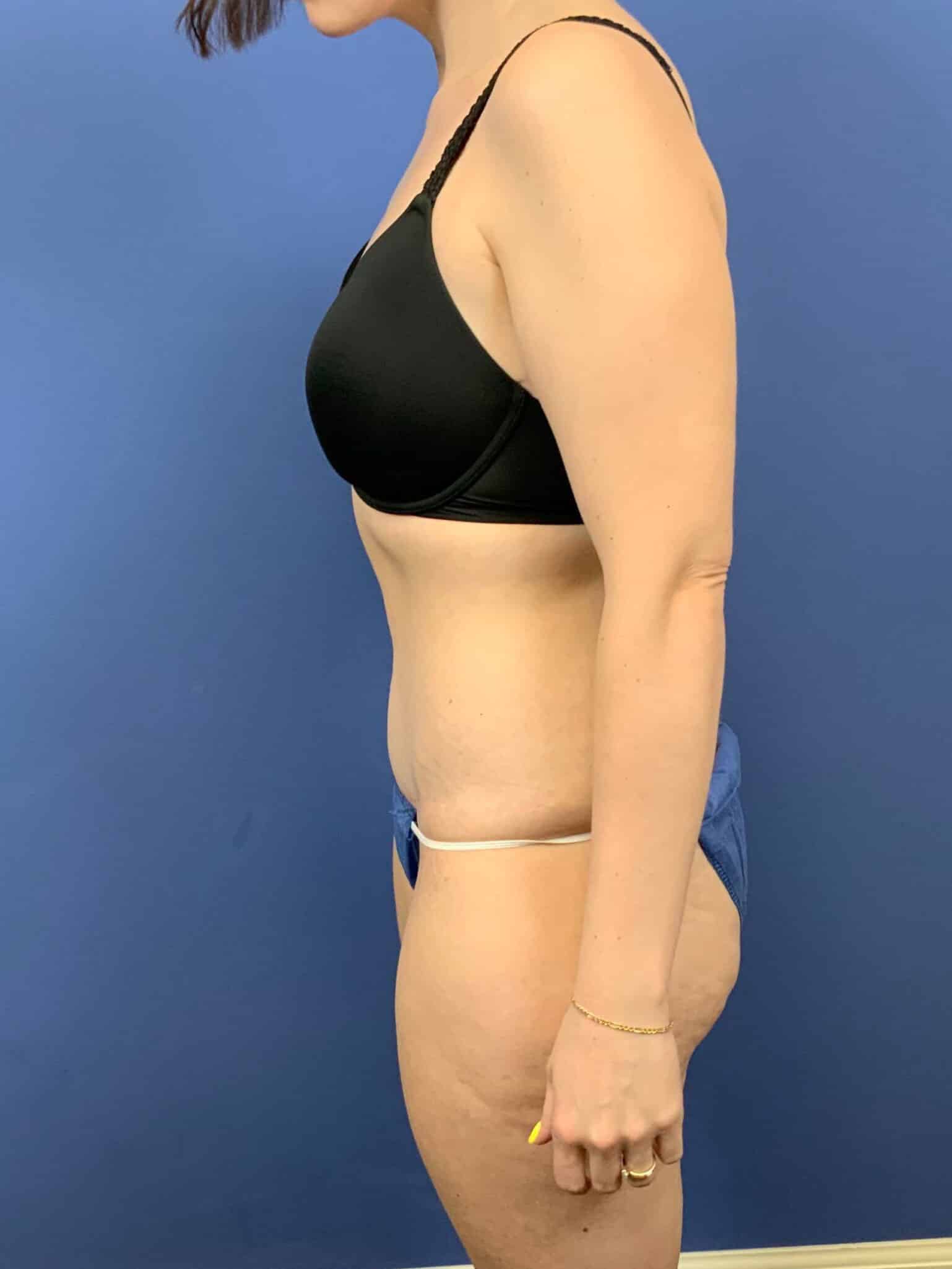 After Image: Tummy Tuck - left-side