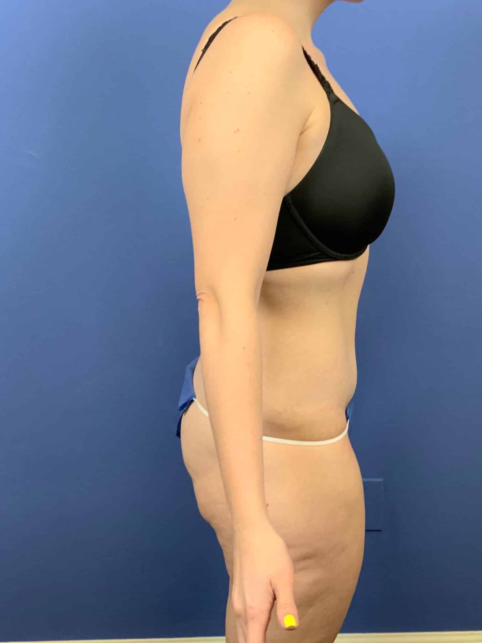After Image: Tummy Tuck - right-side