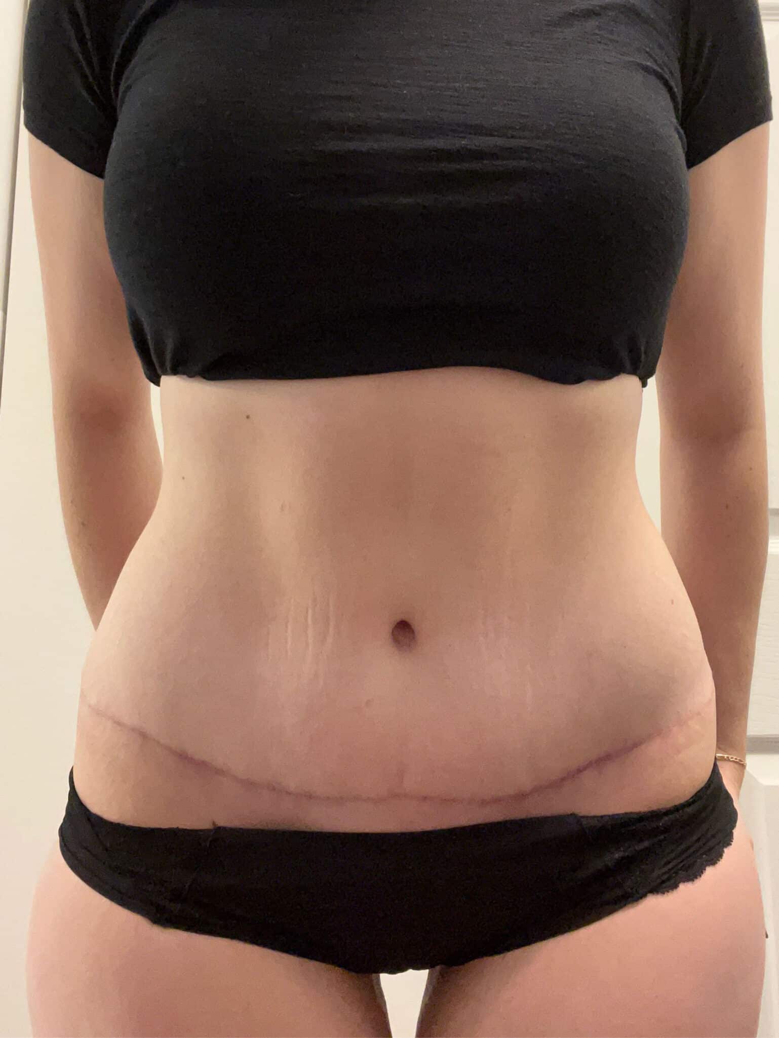 After Image: Tummy Tuck - front