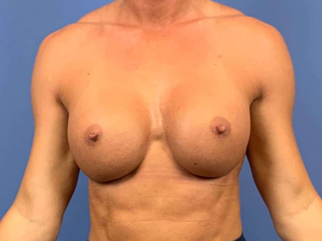 After Image: Patient 44160 - front