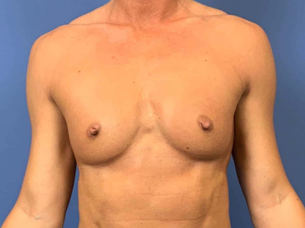 Before Image: Patient 44160 - front