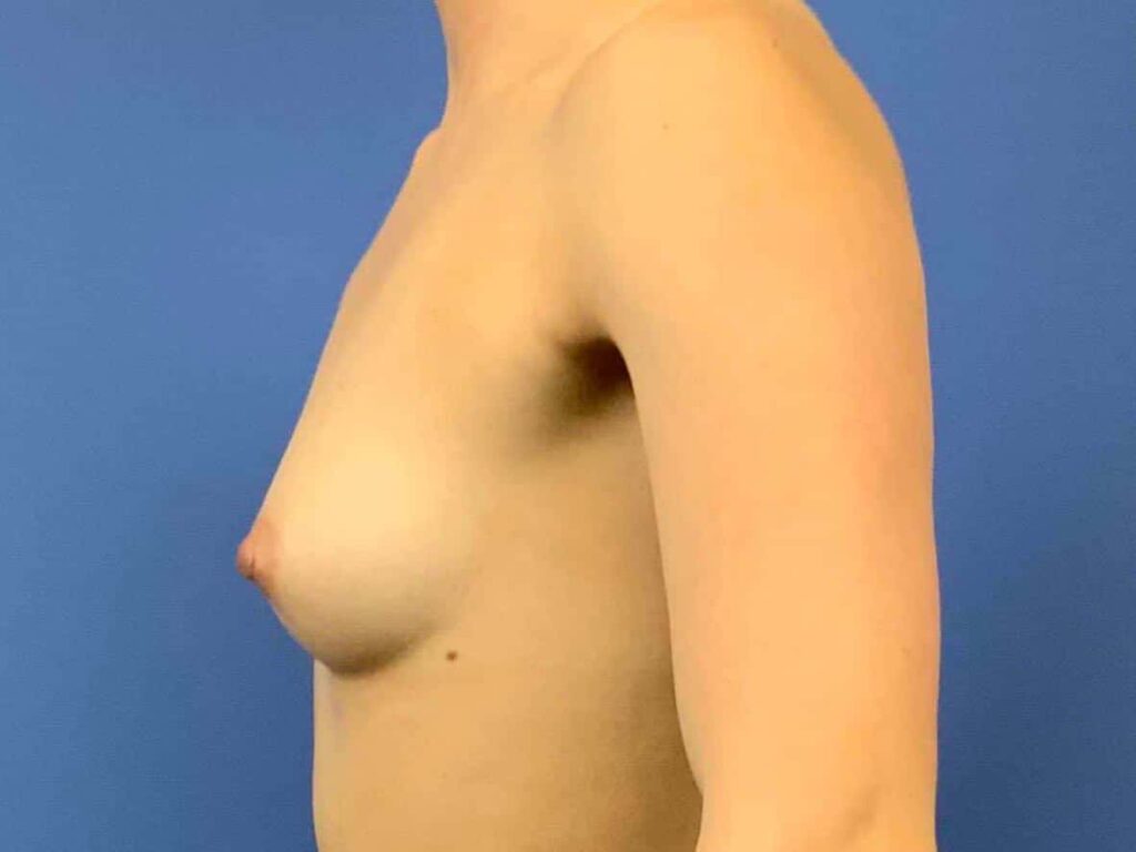 Before Image: Patient 43953 - left-side