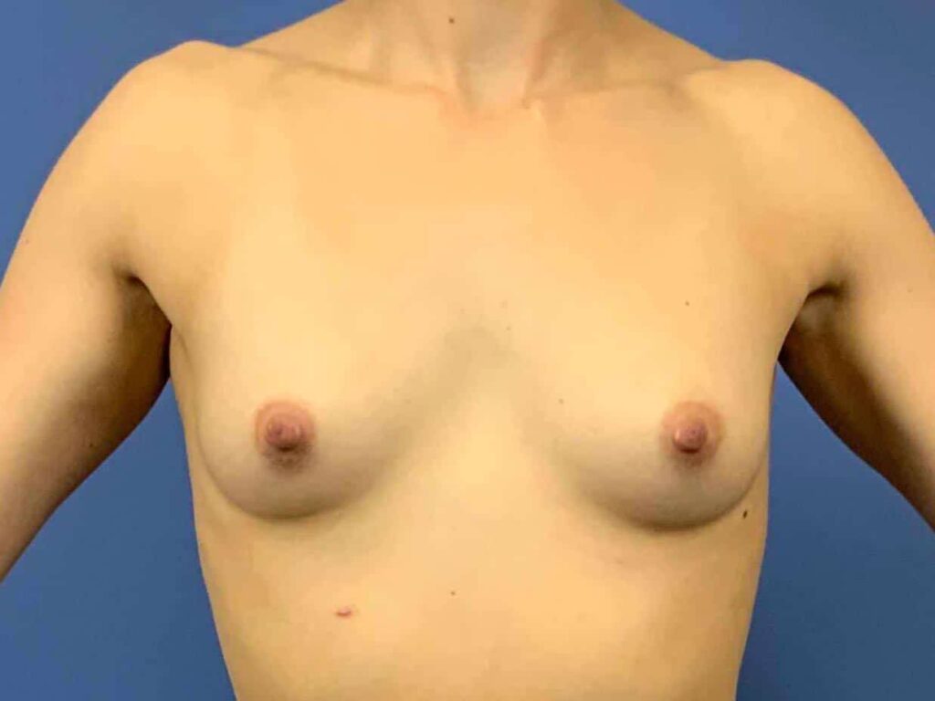 Before Image: Patient 43953 - front