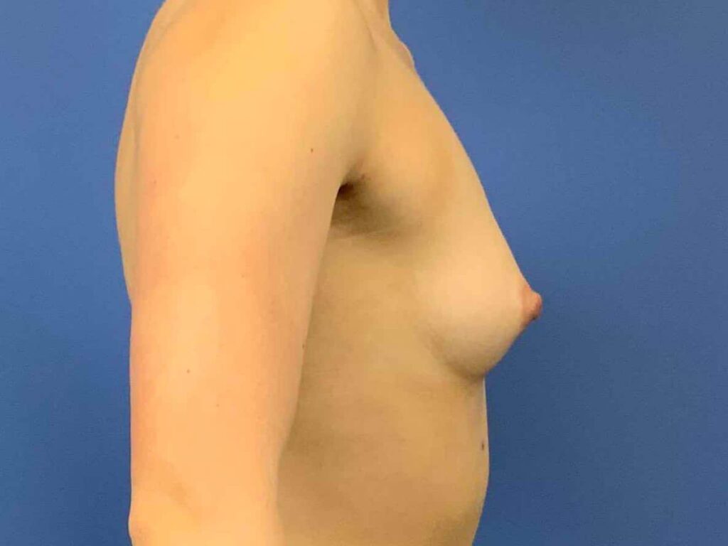 Before Image: Patient 43953 - right-side