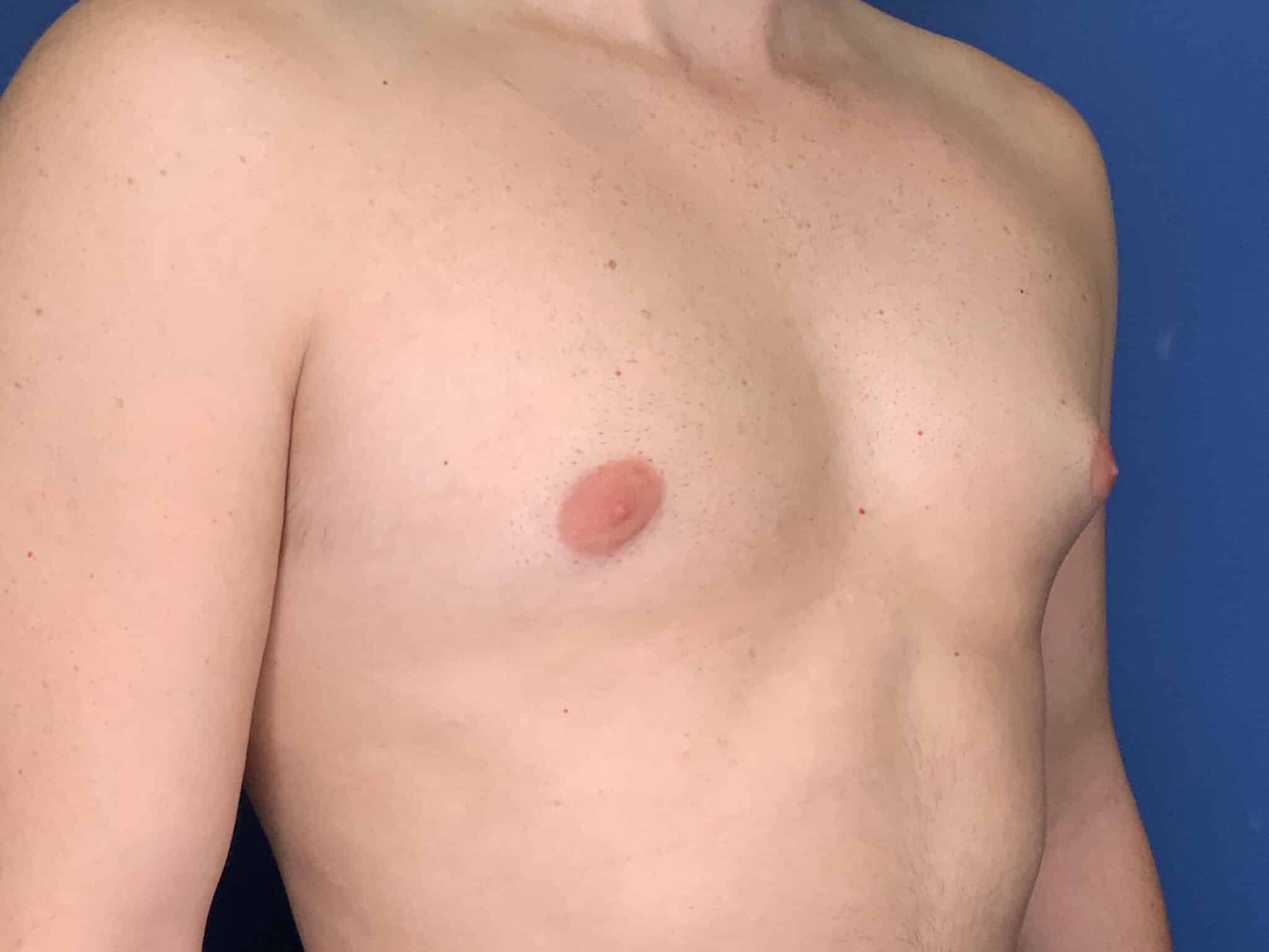 Before Image: Patient 44000 - right-front-oblique