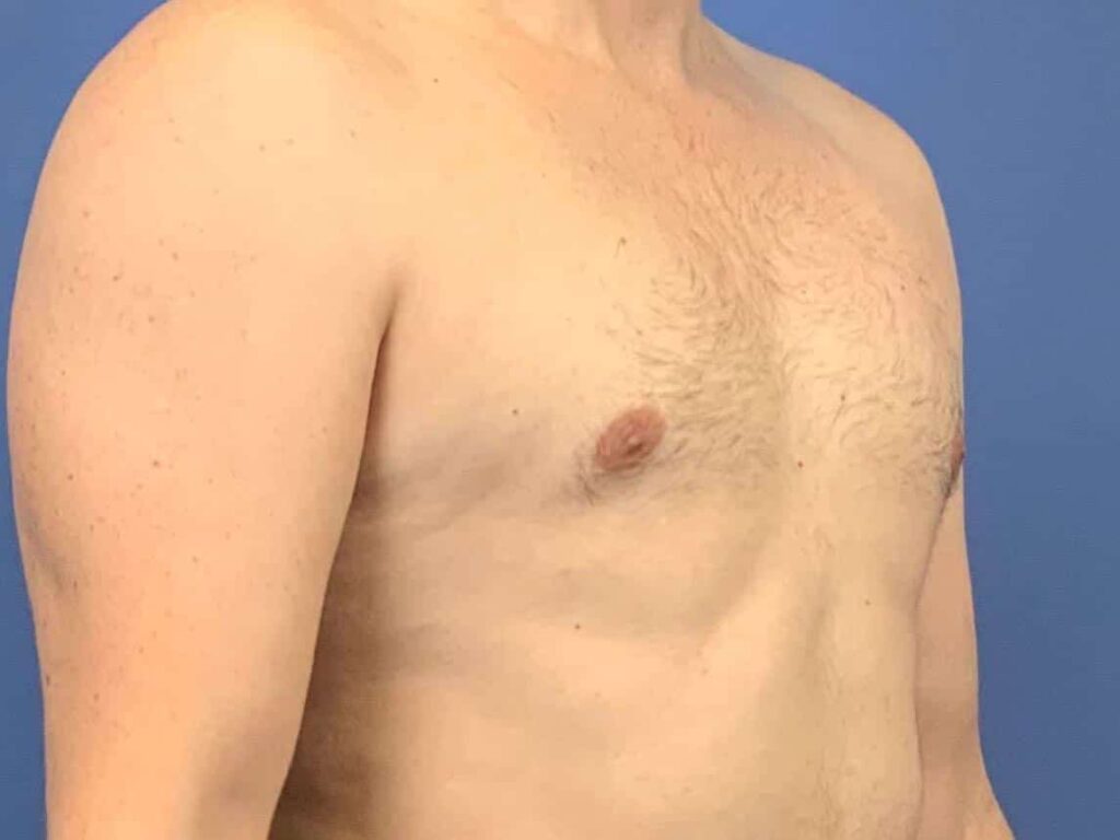 After Image: Patient 44000 - right-front-oblique