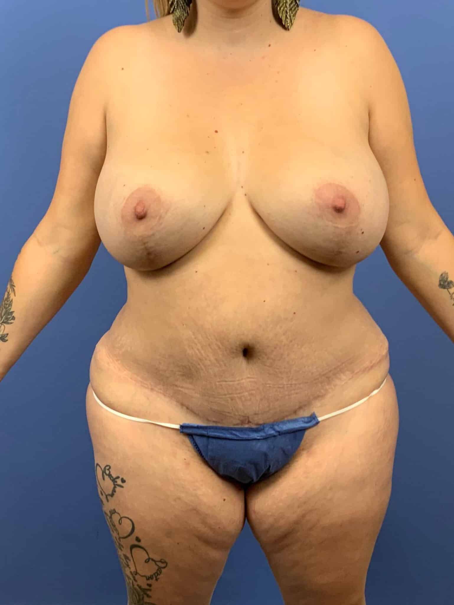 After Image: Patient 44106 - front