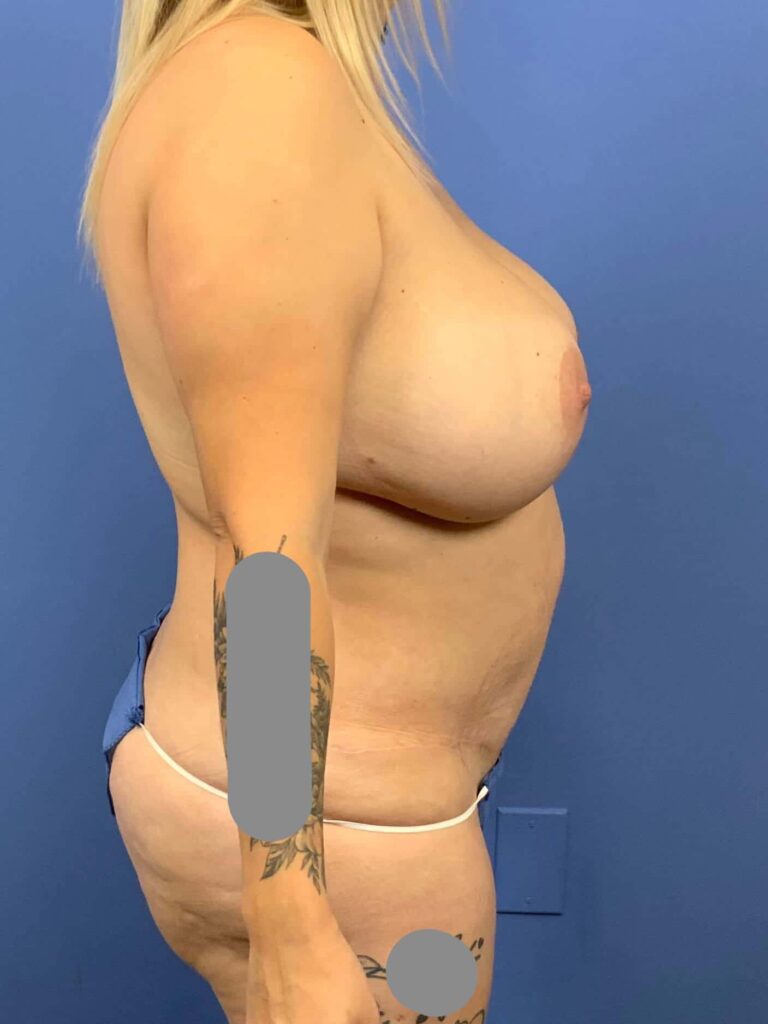 After Image: Patient 44106 - right-side