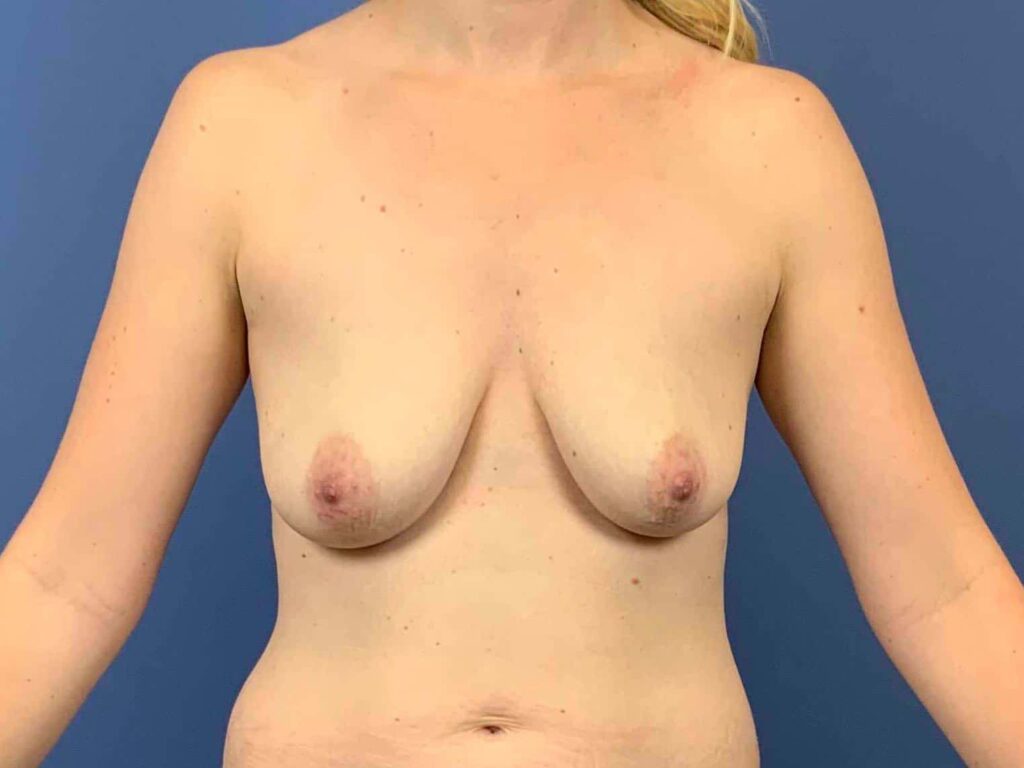 Before Image: Patient 44009 - front