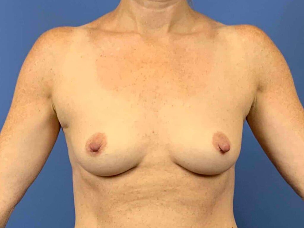Before Image: Patient 43896 - front