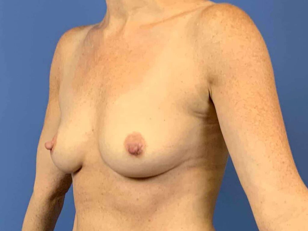 Before Image: Patient 43896 - left-front-oblique