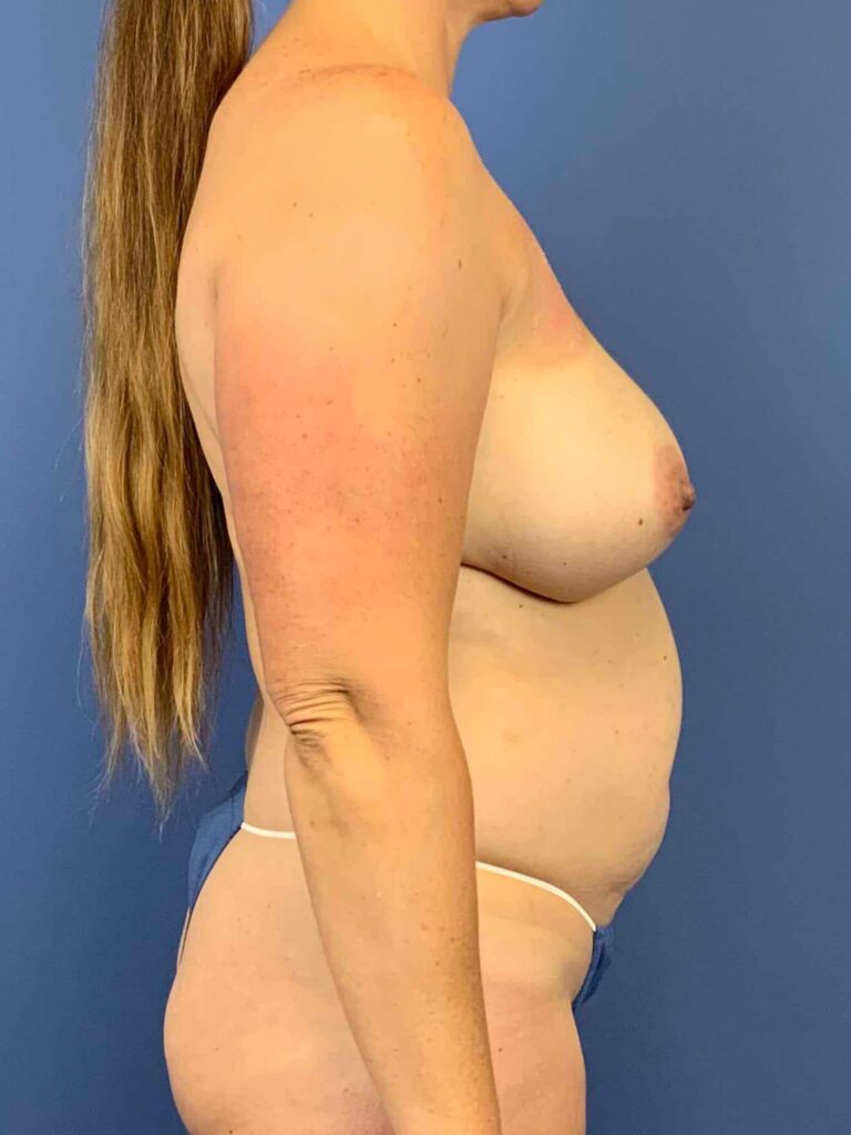 Before Image: Patient 44139 - right-side