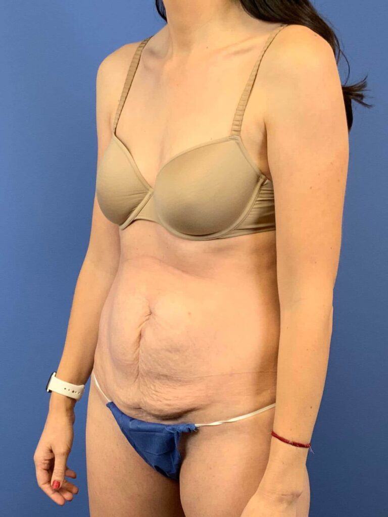 Before Image: Patient 44032 - front