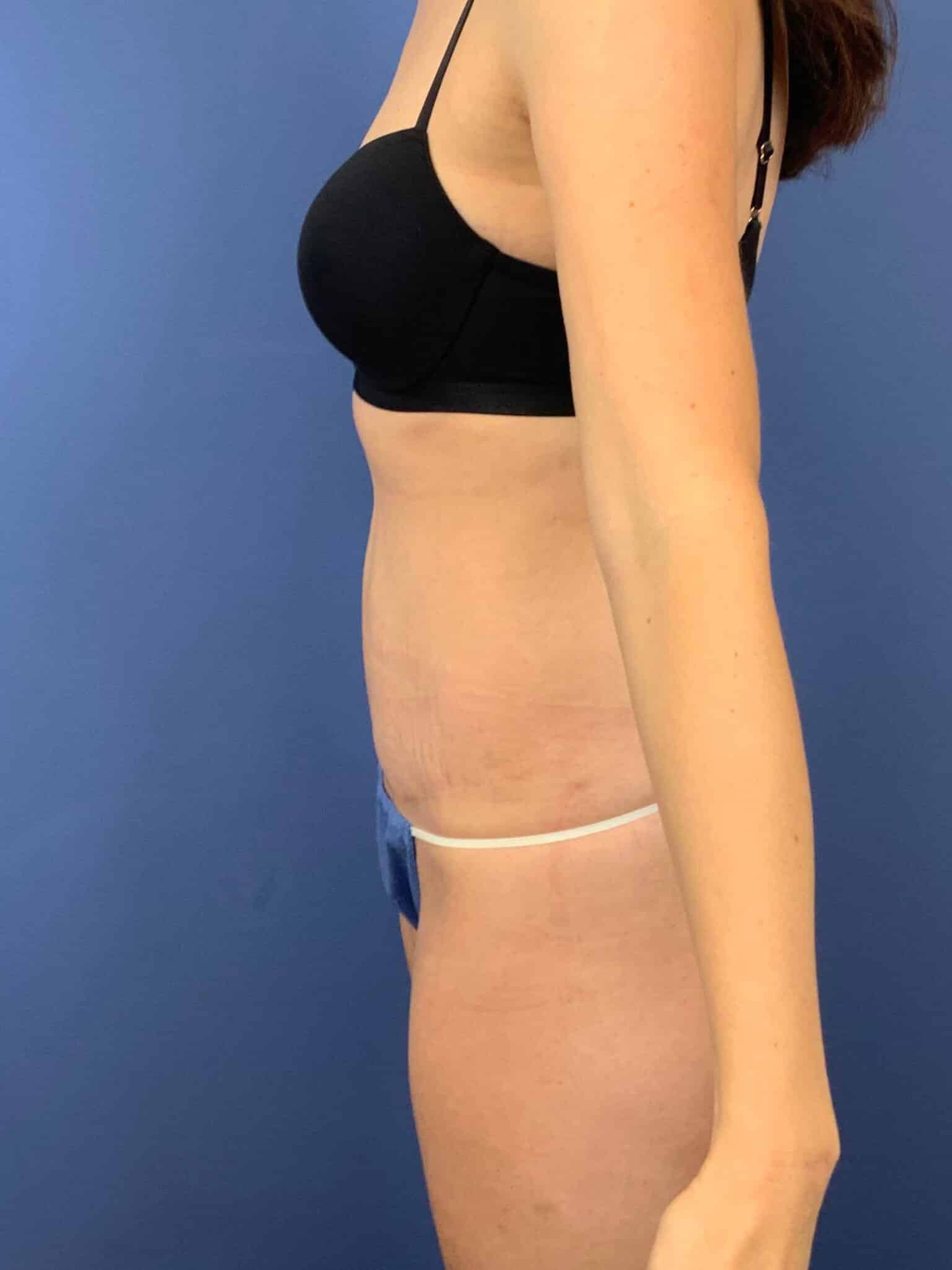 After Image: Patient 44032 - left-side