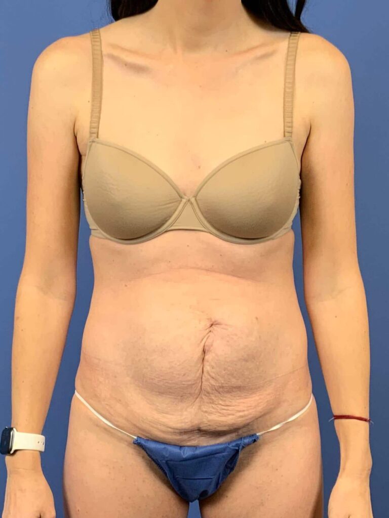 Before Image: Patient 44032 - front