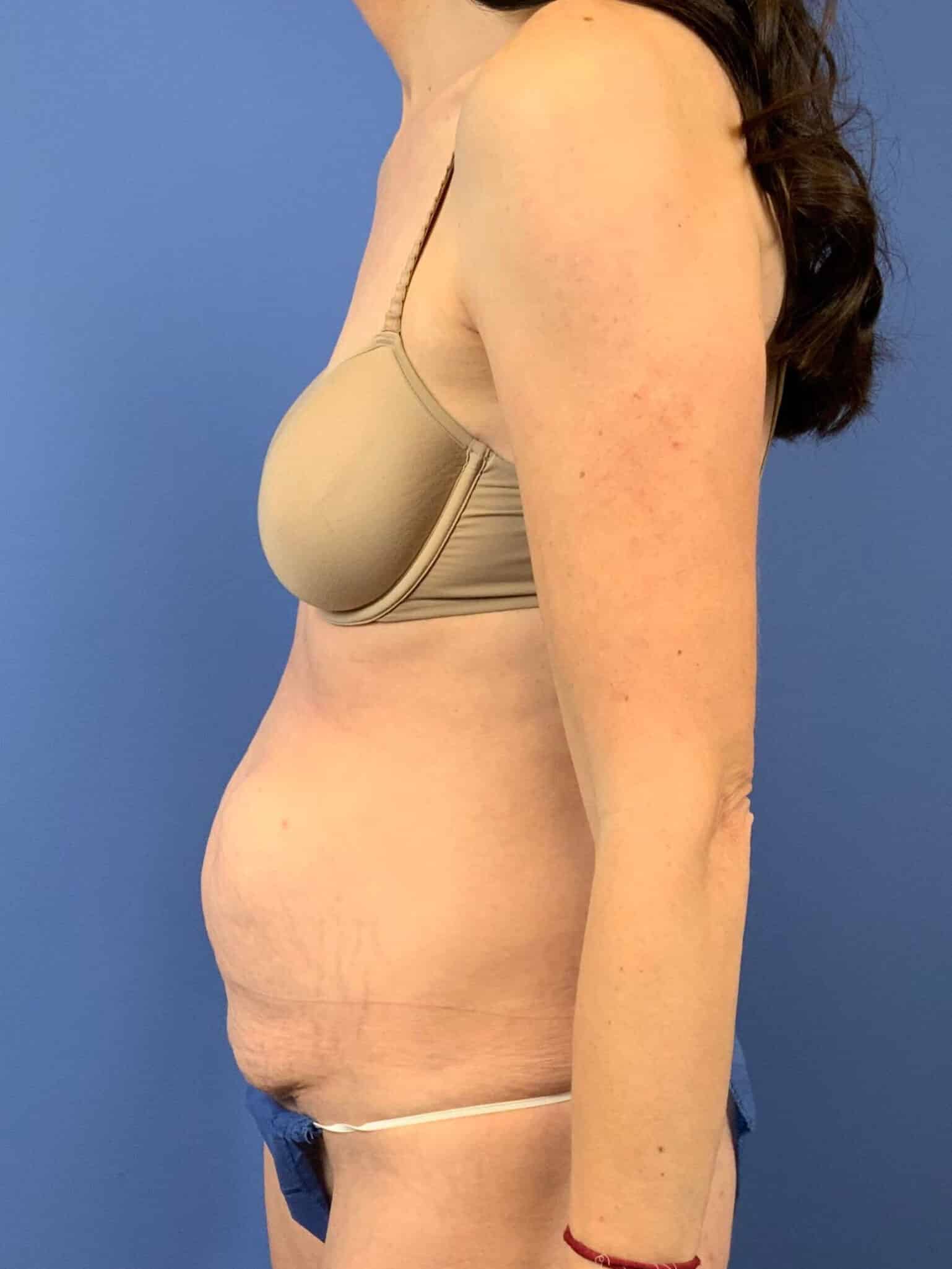 Before Image: Patient 44032 - left-side