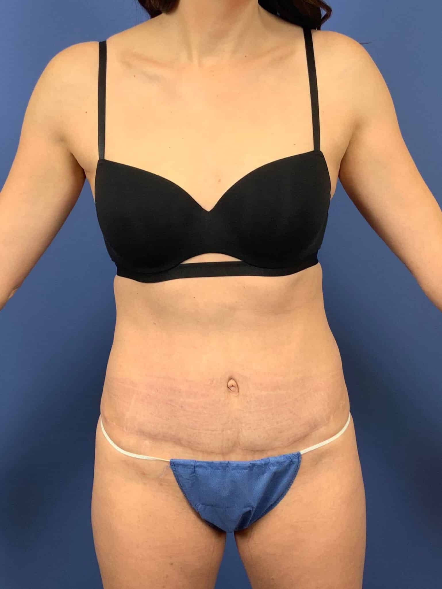 After Image: Patient 44032 - front