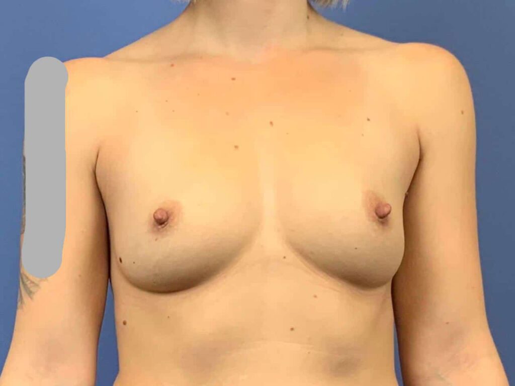 Before Image: Patient 43929 - front