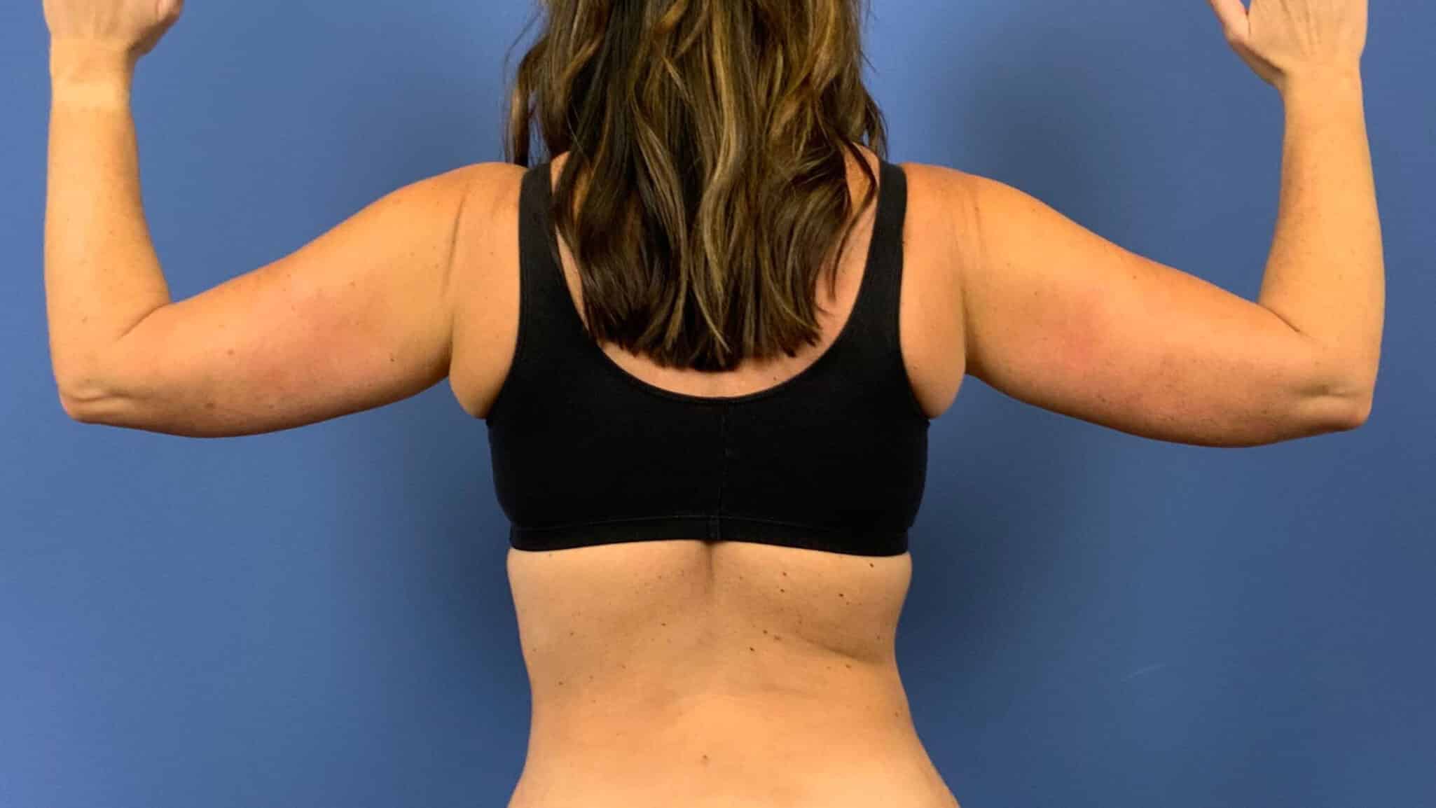 Before Image: Patient 44055 - back