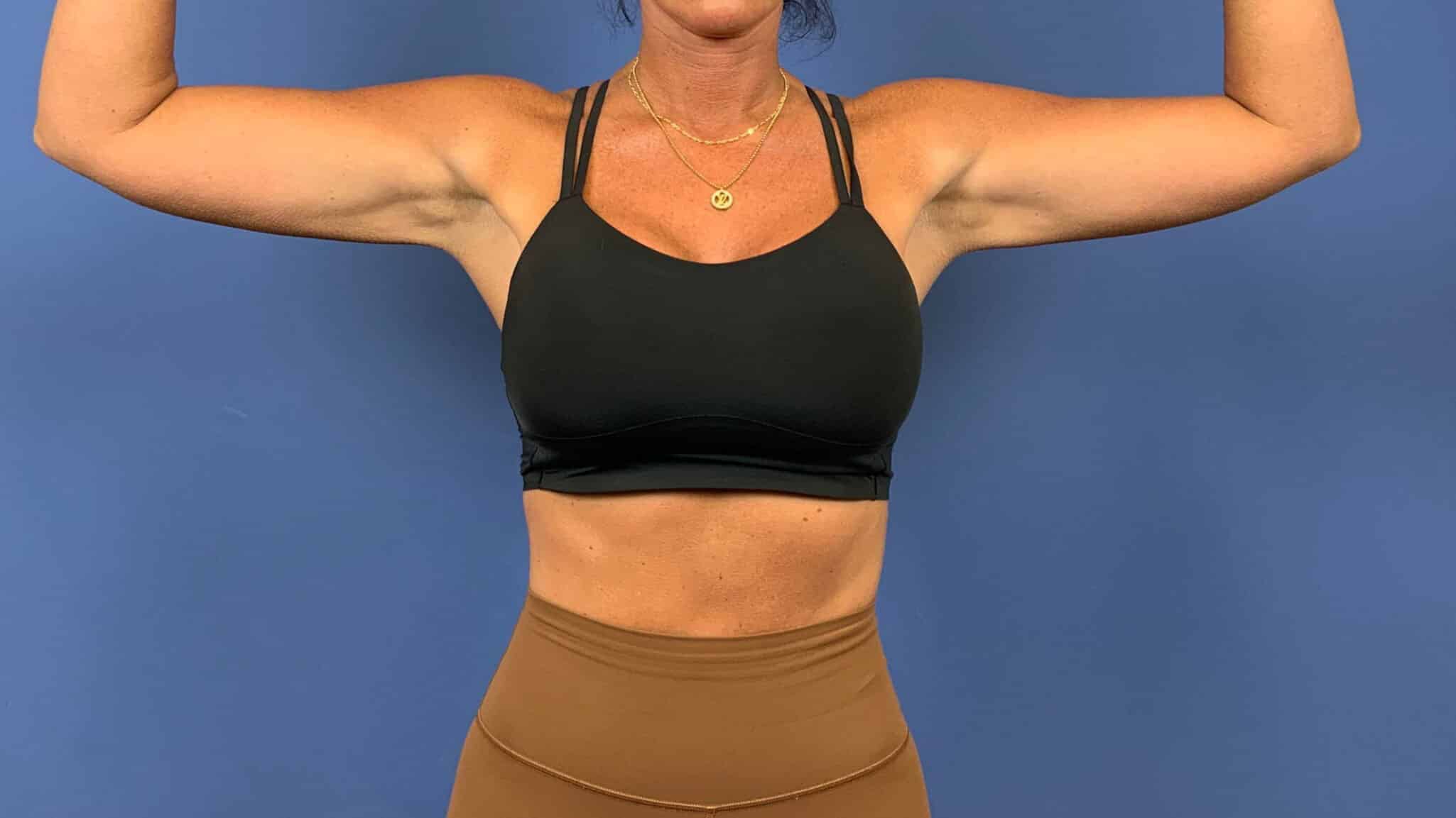 After Image: Patient 44055 - front