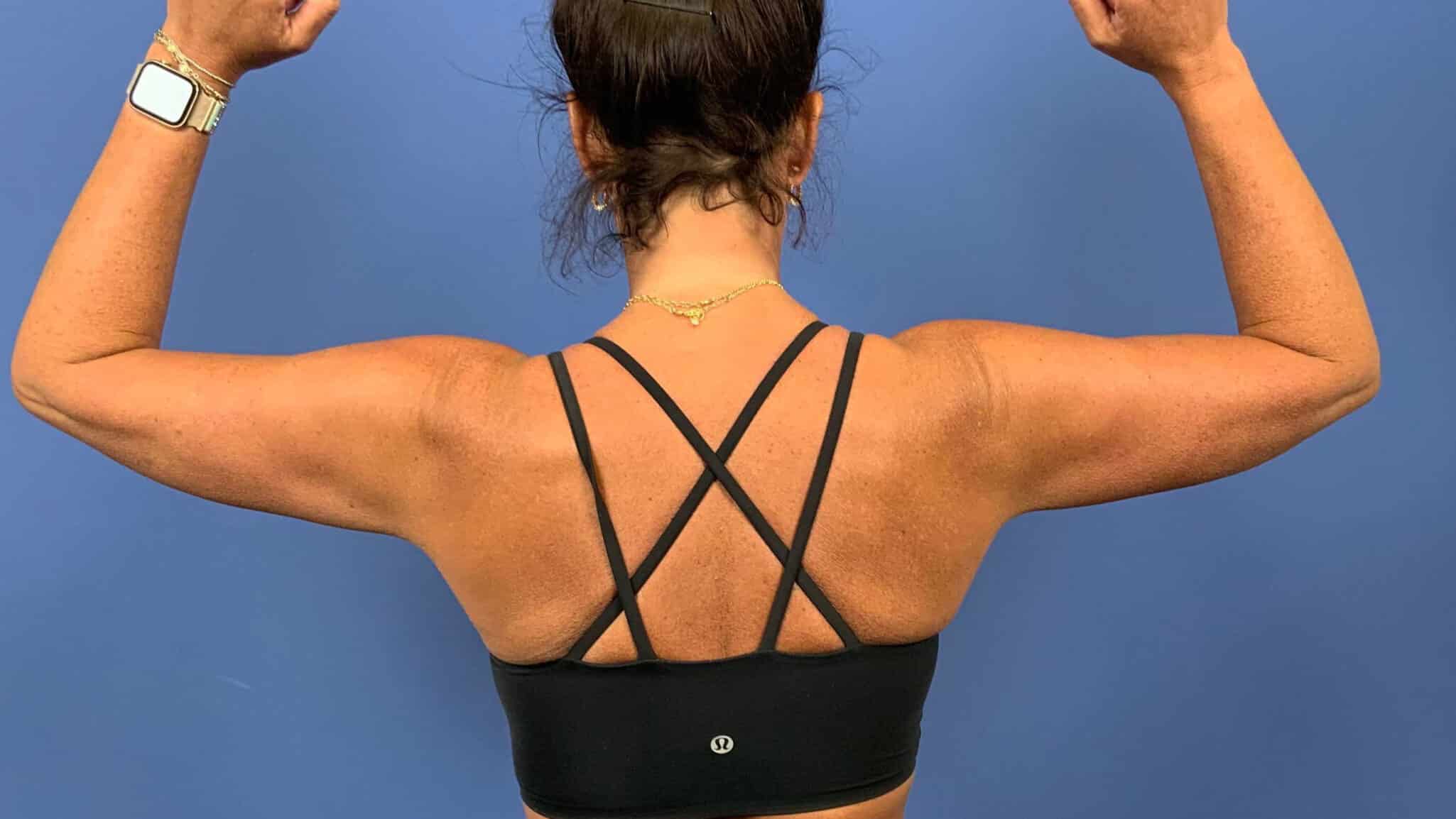 After Image: Patient 44055 - back