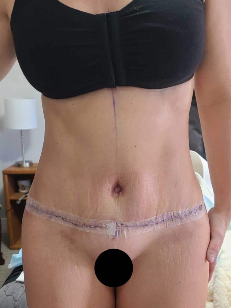 After Image: Patient 43917 - front