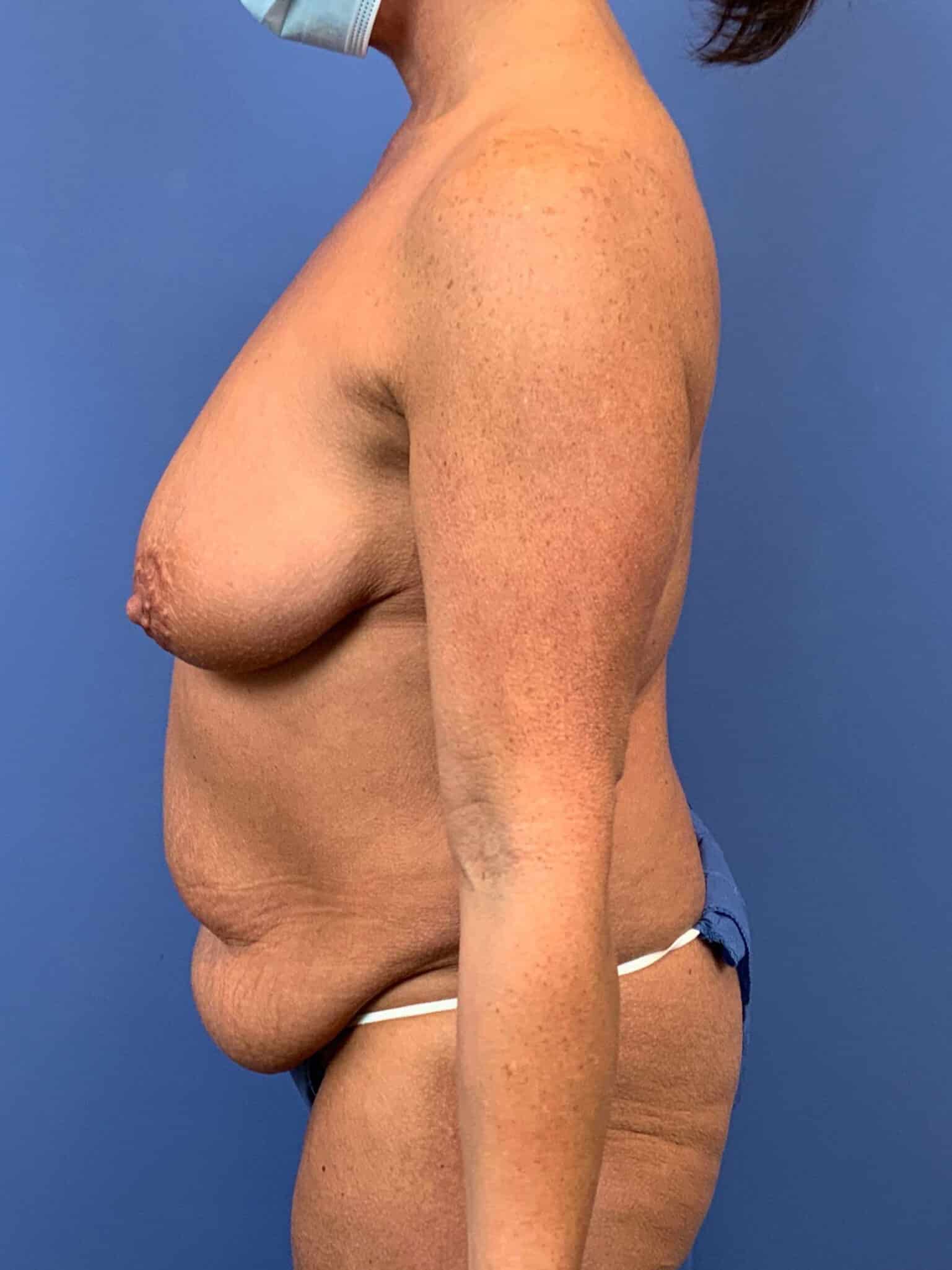 Before Image: Patient 44125 - left-side