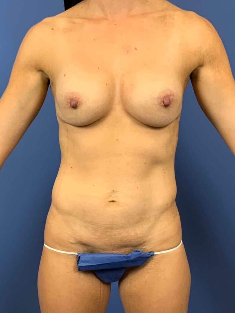 Before Image: Patient 44066 - front