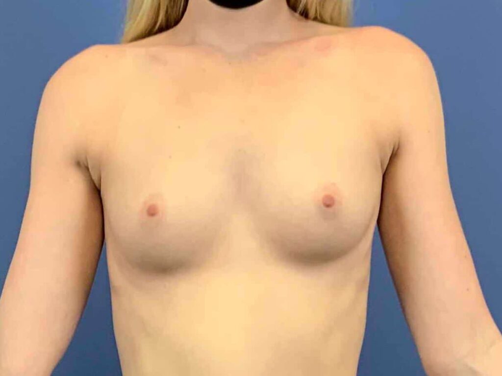 Before Image: Patient 44087 - front