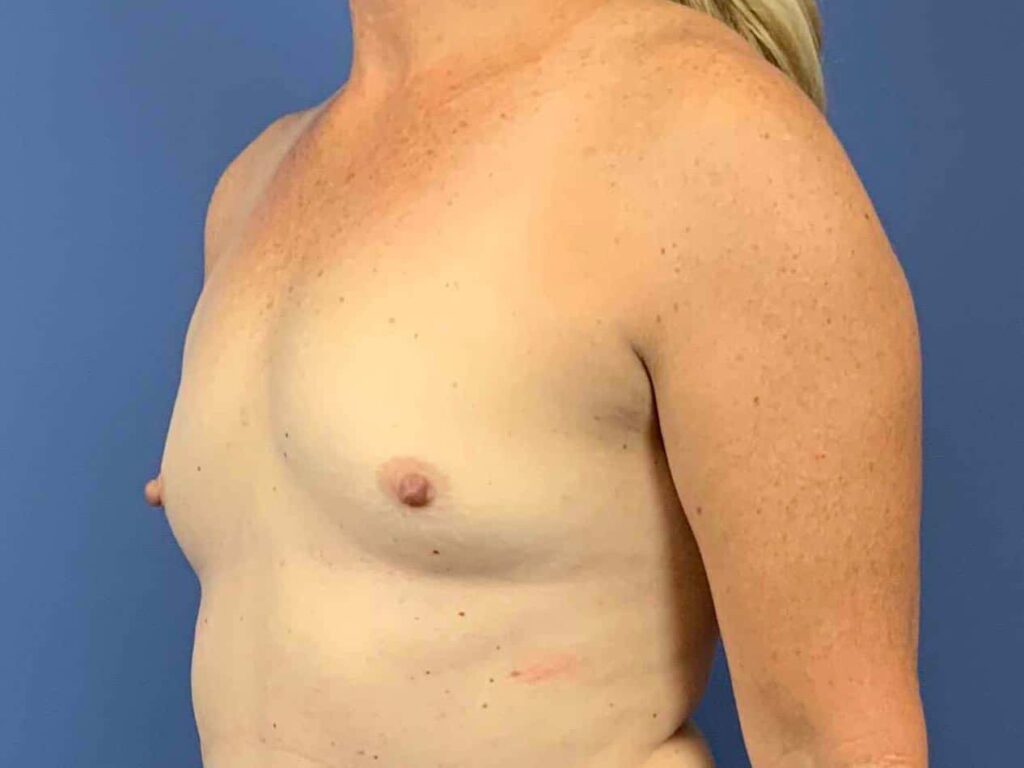 Before Image: Patient 44132 - left-front-oblique