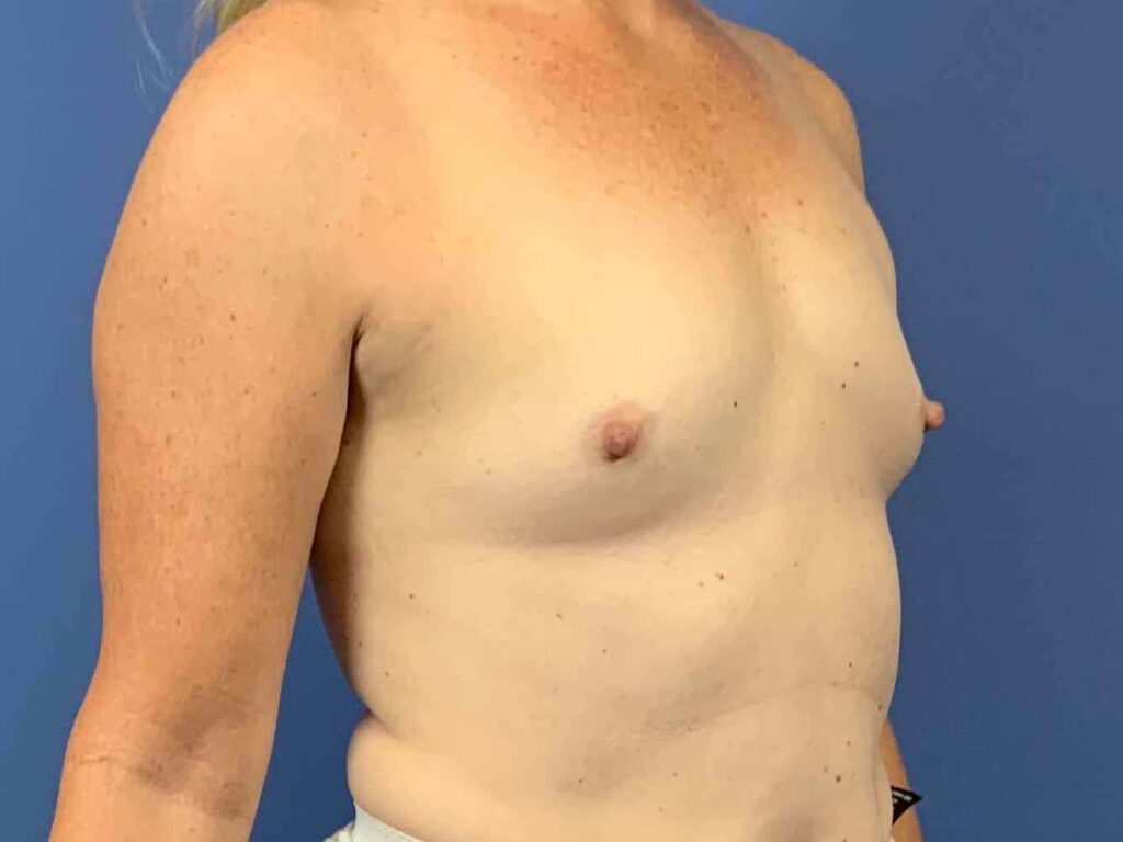 Before Image: Patient 44132 - right-front-oblique