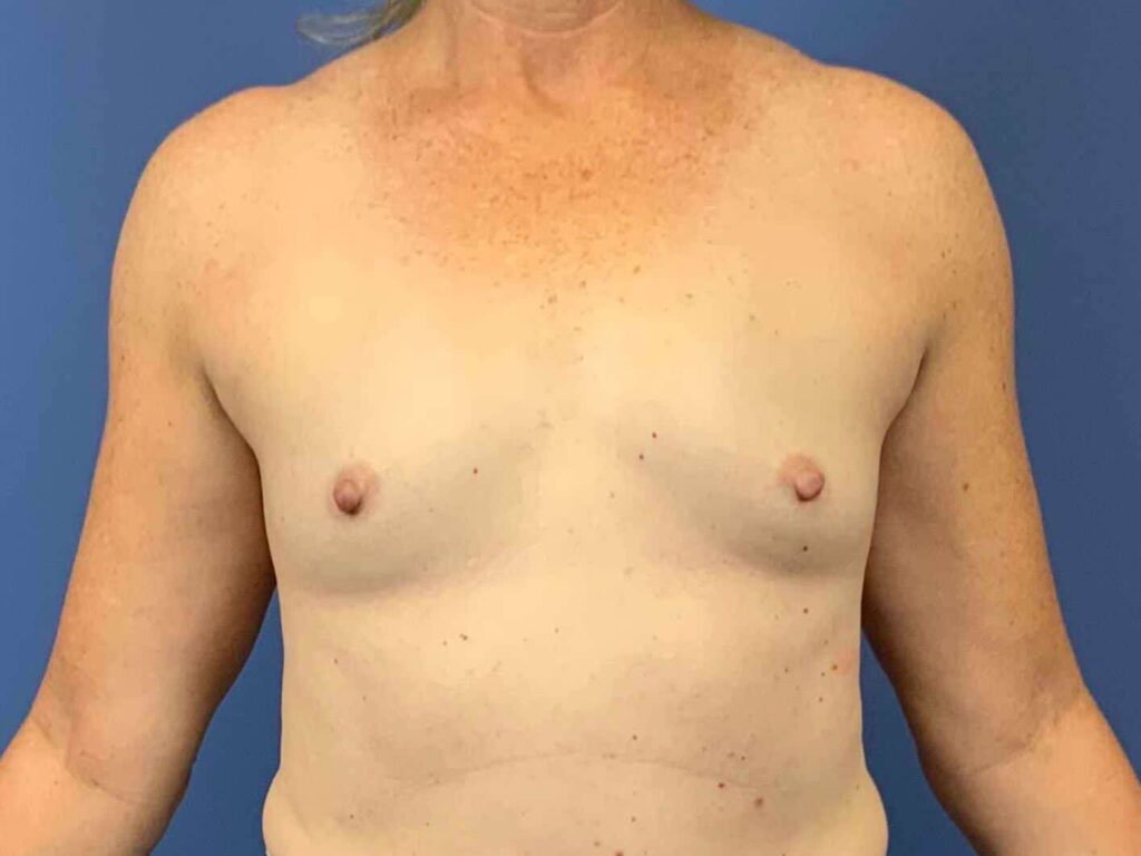 Before Image: Patient 44132 - front