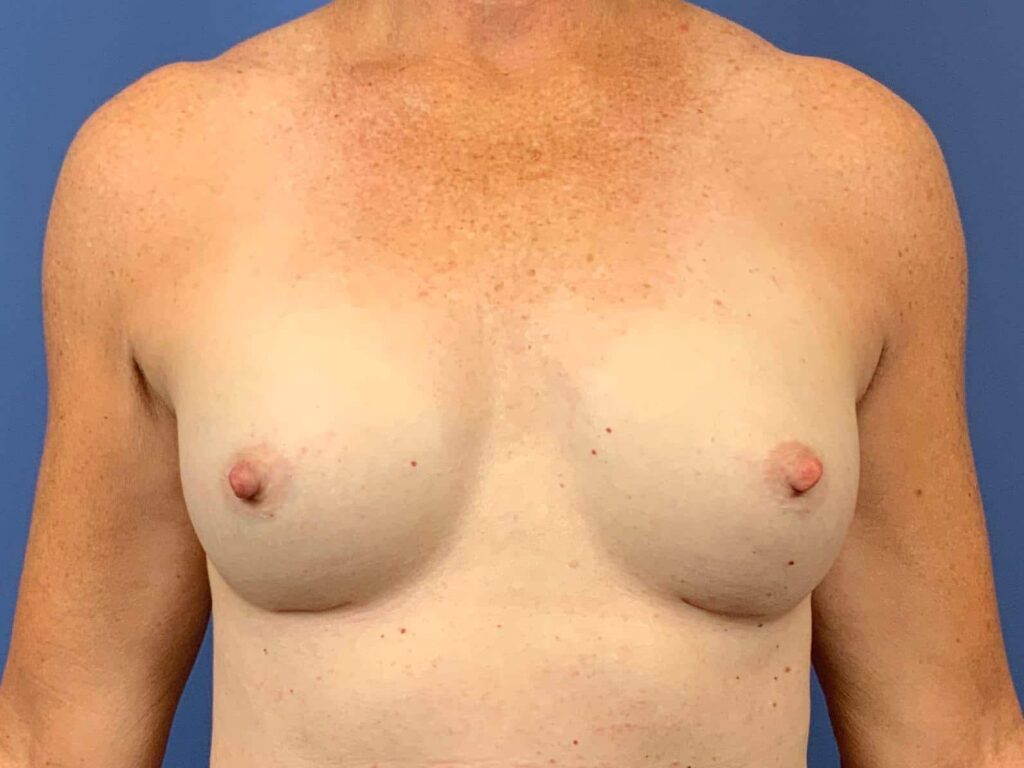 After Image: Patient 44132 - front