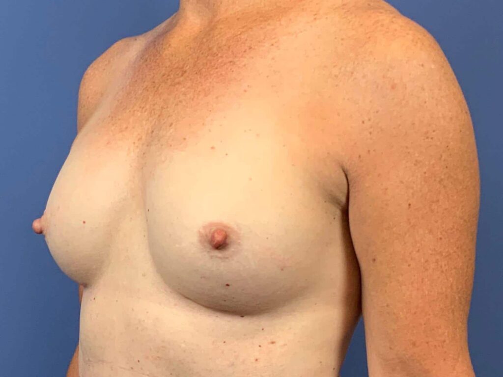 After Image: Patient 44132 - left-front-oblique