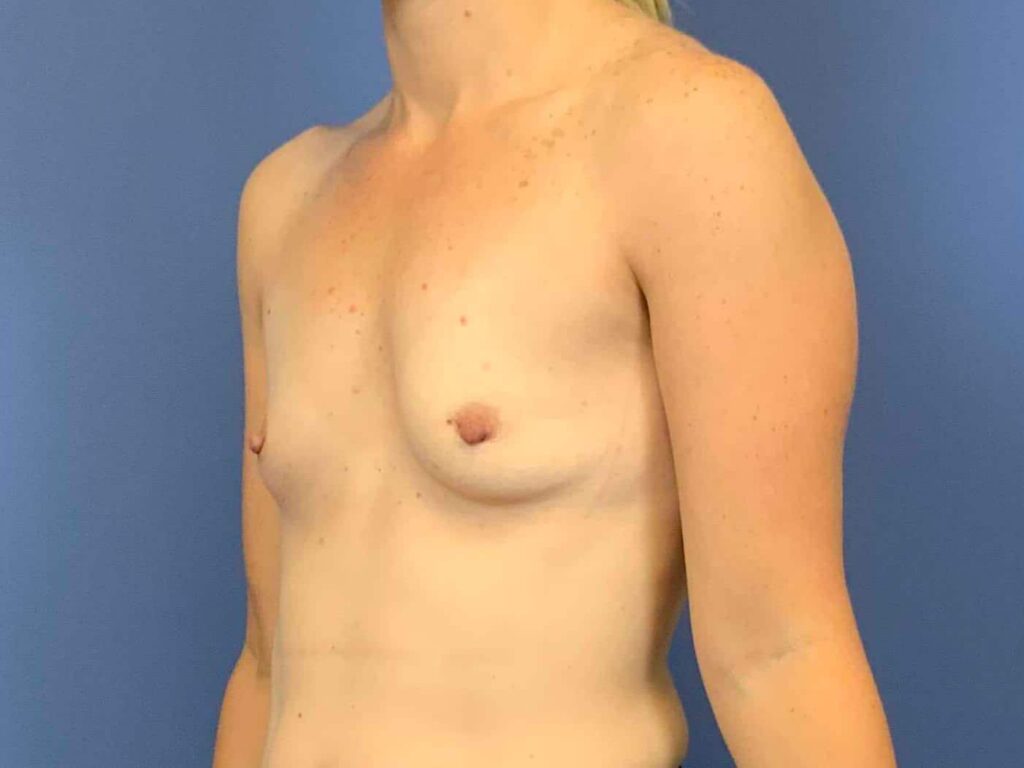 Before Image: Patient 43973 - left-front-oblique