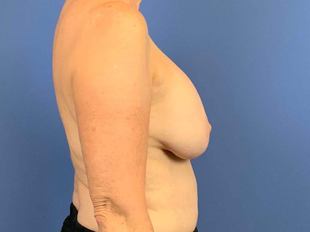 Before Image: Patient 43962 - right-side