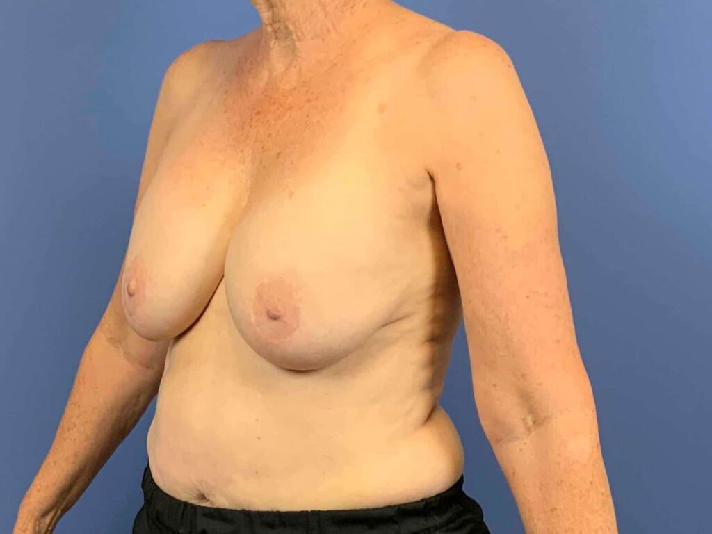 Before Image: Patient 43962 - front