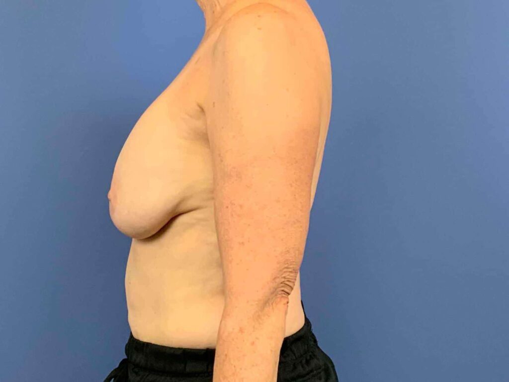 Before Image: Patient 43962 - left-side