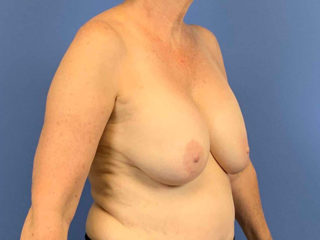 Before Image: Patient 43962 - right-front-oblique