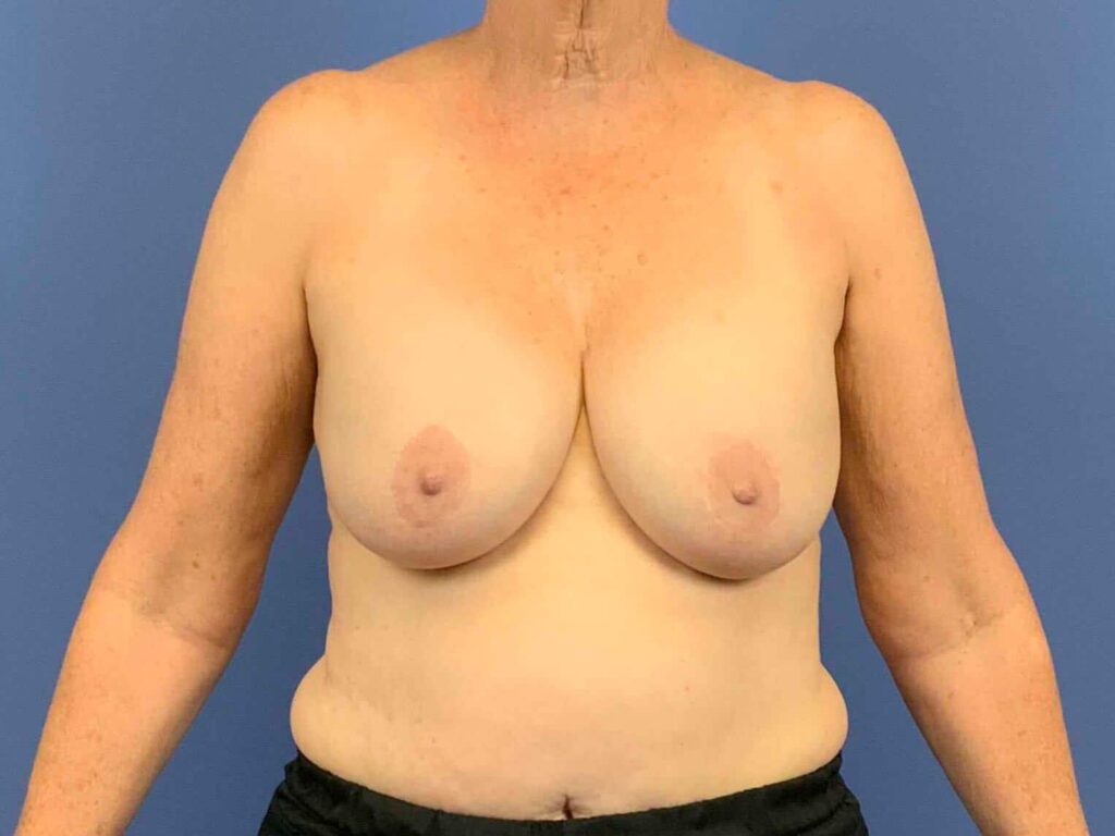 Before Image: Patient 43962 - front