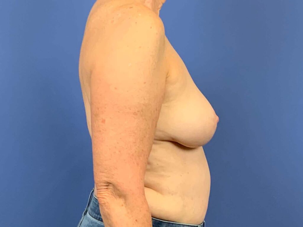 After Image: Patient 43962 - right-side