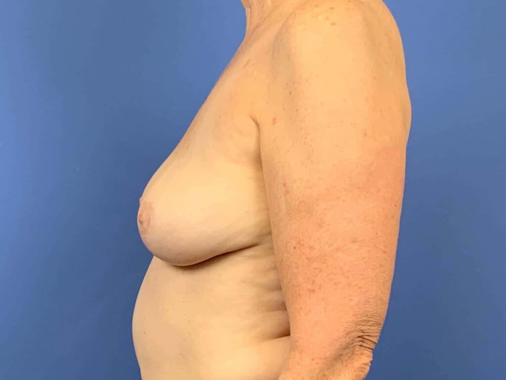 After Image: Patient 43962 - left-side